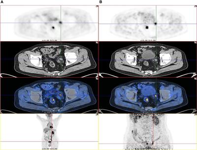 Use of F-18 FDG PET/CT Through Delayed Diuretic Imaging for Preoperative Evaluation of Upper Urinary Tract-Occupying Lesions